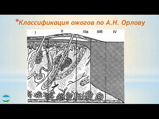 Классификация ожогов по А.Н. Орлову