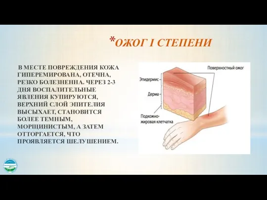 ОЖОГ I СТЕПЕНИ В МЕСТЕ ПОВРЕЖДЕНИЯ КОЖА ГИПЕРЕМИРОВАНА, ОТЕЧНА, РЕЗКО