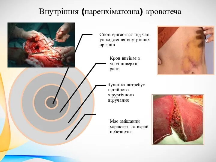 Внутрішня (паренхіматозна) кровотеча