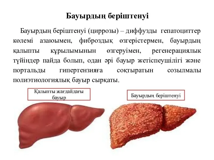 Бауырдың беріштенуі Бауырдың беріштенуі (циррозы) – диффузды гепатоциттер көлемі азаюымен,