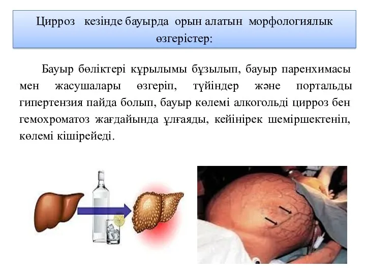 Цирроз кезінде бауырда орын алатын морфологиялык өзгерістер: Бауыр бөліктері кұрылымы