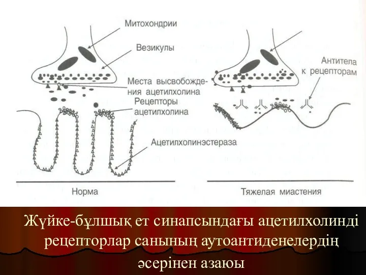Жүйке-бұлшық ет синапсындағы ацетилхолинді рецепторлар санының аутоантиденелердің әсерінен азаюы