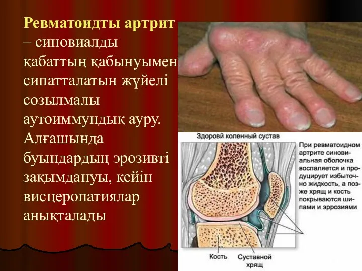 Ревматоидты артрит – синовиалды қабаттың қабынуымен сипатталатын жүйелі созылмалы аутоиммундық