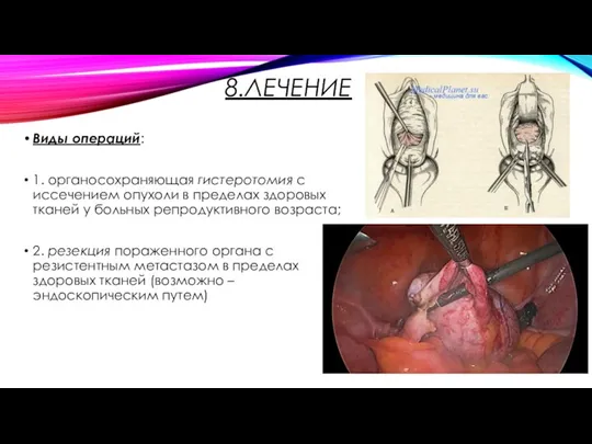 8.ЛЕЧЕНИЕ Виды операций: 1. органосохраняющая гистеротомия с иссечением опухоли в