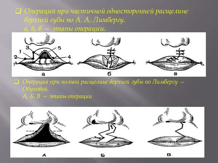 Операция при частичной односторонней расщелине верхней губы по А. А. Лимбергу. а, 6,