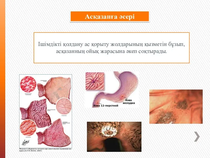 Асқазанға әсері Ішімдікті қолдану ас қорыту жолдарының қызметін бұзып, асқазанның ойық жарасына әкеп соқтырады.