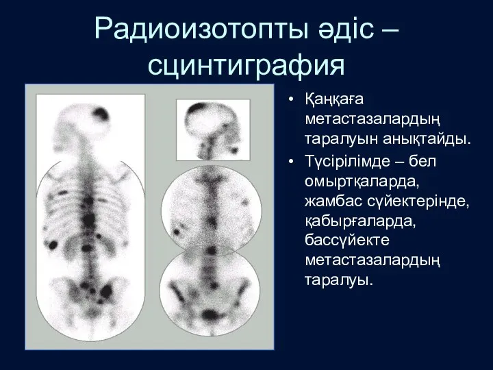 Радиоизотопты әдіс – сцинтиграфия Қаңқаға метастазалардың таралуын анықтайды. Түсірілімде – бел омыртқаларда, жамбас