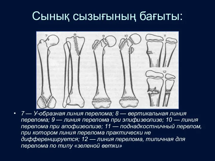 Сынық сызығының бағыты: 7 — У-образная линия перелома; 8 — вертикальная линия перелома;