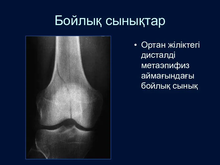 Бойлық сынықтар Ортан жіліктегі дисталді метаэпифиз аймағындағы бойлық сынық