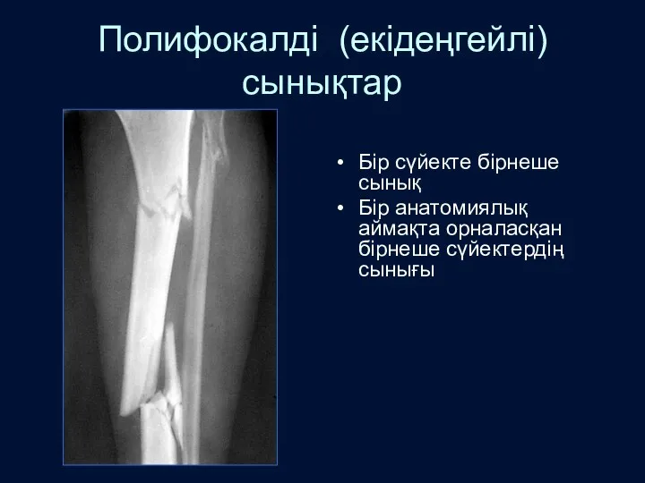 Полифокалді (екідеңгейлі) сынықтар Бір сүйекте бірнеше сынық Бір анатомиялық аймақта орналасқан бірнеше сүйектердің сынығы