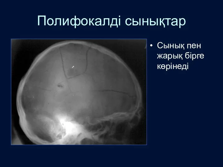 Полифокалді сынықтар Сынық пен жарық бірге көрінеді