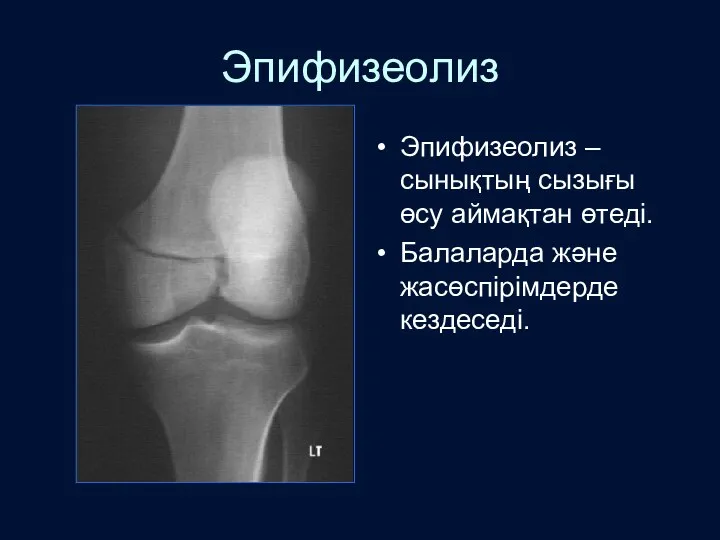 Эпифизеолиз Эпифизеолиз –сынықтың сызығы өсу аймақтан өтеді. Балаларда және жасөспірімдерде кездеседі.