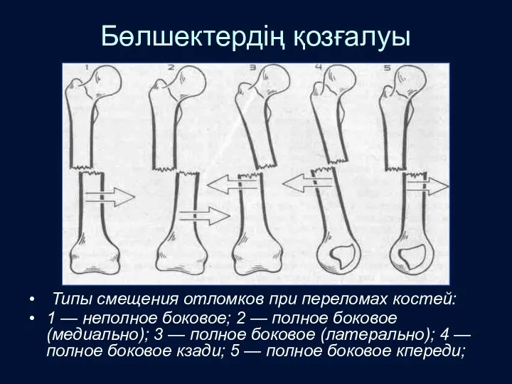 Бөлшектердің қозғалуы Типы смещения отломков при переломах костей: 1 —