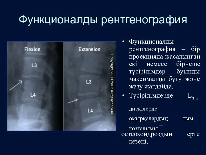 Функционалды рентгенография Функционалды рентгенография – бір проекцияда жасалынған екі немесе бірнеше түсірілімдер буынды