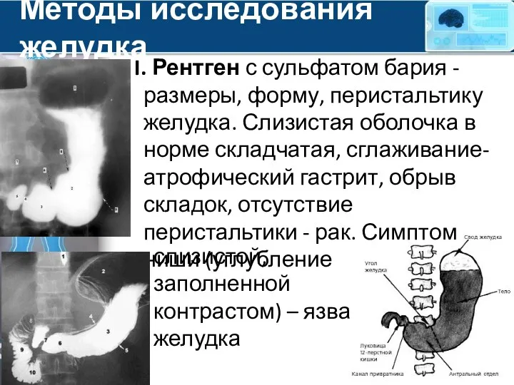Методы исследования желудка I. Рентген с сульфатом бария - размеры, форму, перистальтику желудка.