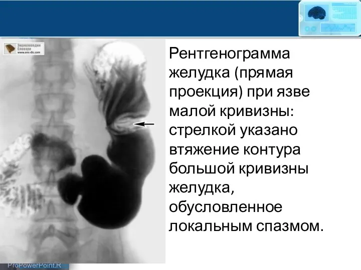 Рентгенограмма желудка (прямая проекция) при язве малой кривизны: стрелкой указано