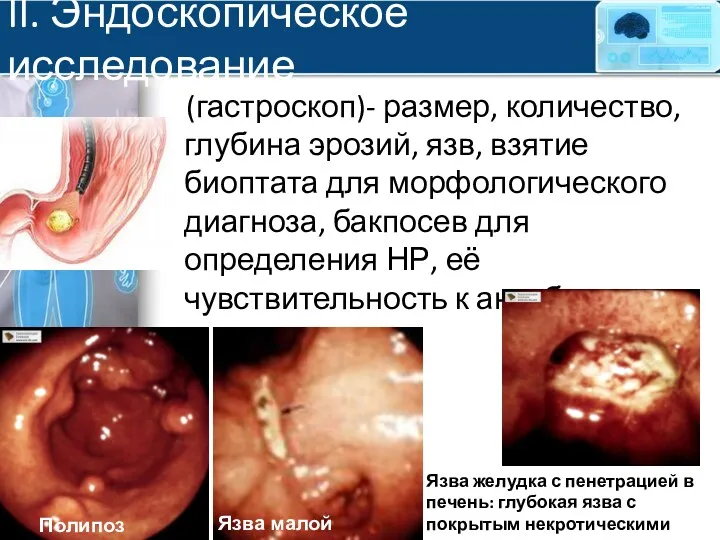 II. Эндоскопическое исследование (гастроскоп)- размер, количество, глубина эрозий, язв, взятие