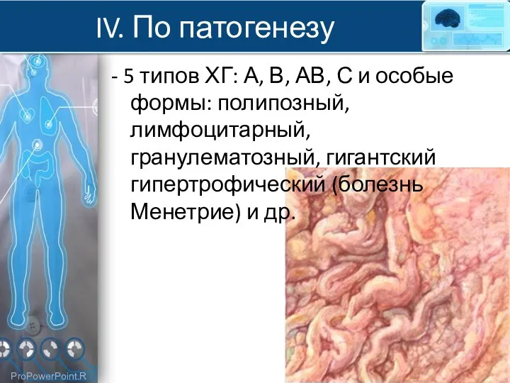 IV. По патогенезу - 5 типов ХГ: А, В, АВ, С и особые