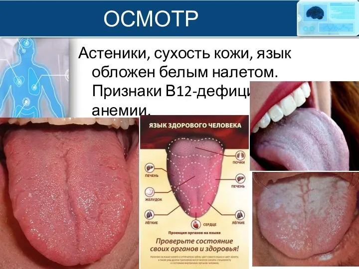 ОСМОТР Астеники, сухость кожи, язык обложен белым налетом. Признаки В12-дефицитной анемии.