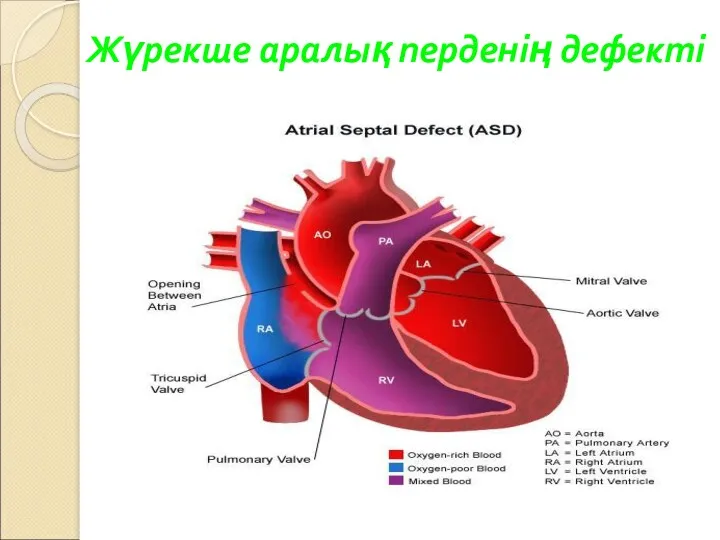 Жүрекше аралық перденің дефекті