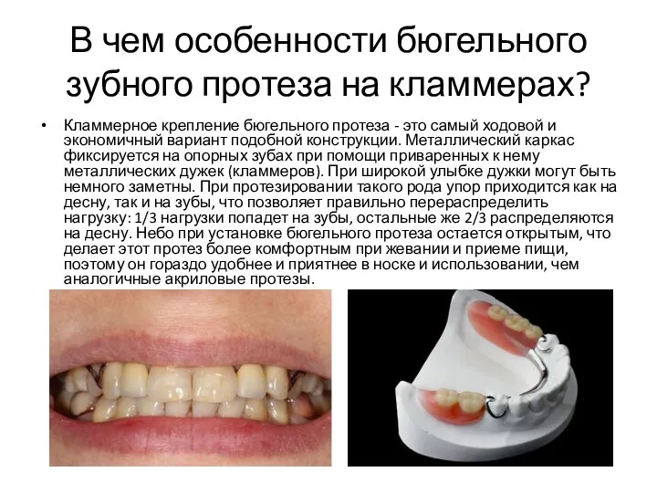 В чем особенности бюгельного зубного протеза на кламмерах? Кламмерное крепление