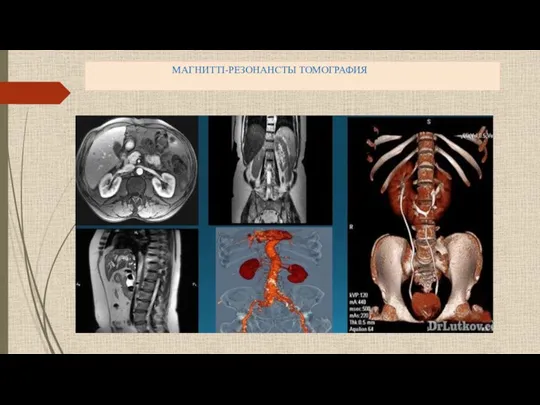МАГНИТТІ-РЕЗОНАНСТЫ ТОМОГРАФИЯ