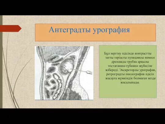 Антеградты урография Бұл зерттеу әдісінде контрастты затты теріасты пункциясы немесе