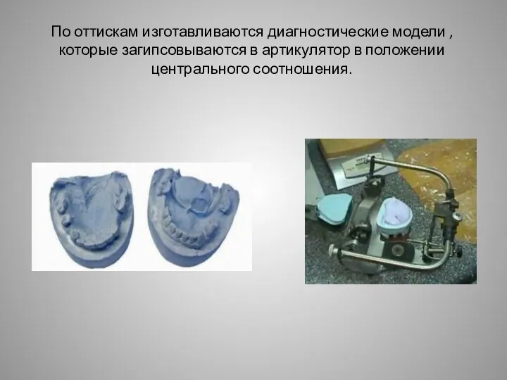 По оттискам изготавливаются диагностические модели ,которые загипсовываются в артикулятор в положении центрального соотношения.