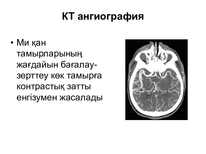 КТ ангиография Ми қан тамырларының жағдайын бағалау- зерттеу көк тамырға контрастық затты енгізумен жасалады