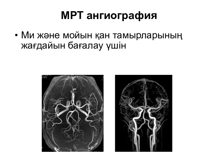 МРТ ангиография Ми және мойын қан тамырларының жағдайын бағалау үшін