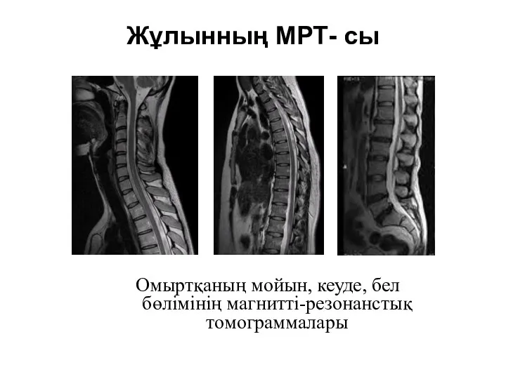 Жұлынның МРТ- сы Омыртқаның мойын, кеуде, бел бөлімінің магнитті-резонанстық томограммалары