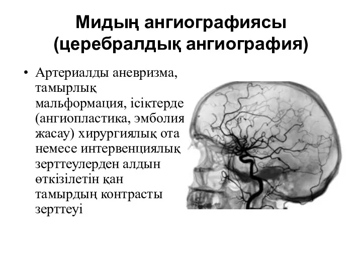 Мидың ангиографиясы (церебралдық ангиография) Артериалды аневризма, тамырлық мальформация, ісіктерде (ангиопластика,