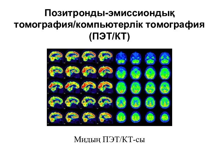 Позитронды-эмиссиондық томография/компьютерлік томография (ПЭТ/КТ) Мидың ПЭТ/КТ-сы