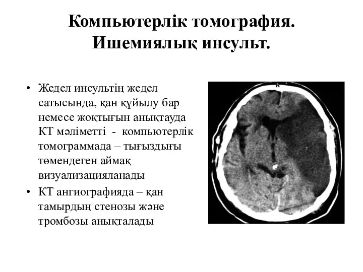 Компьютерлік томография. Ишемиялық инсульт. Жедел инсультің жедел сатысында, қан құйылу