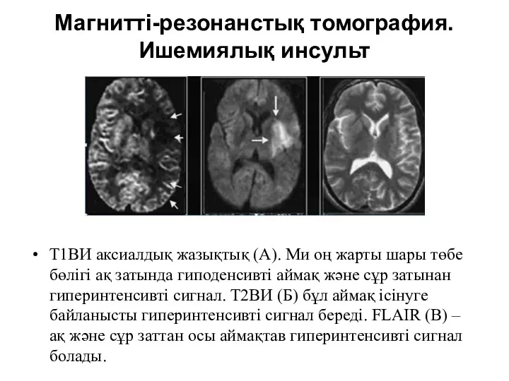 Магнитті-резонанстық томография. Ишемиялық инсульт Т1ВИ аксиалдық жазықтық (А). Ми оң