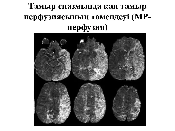 Тамыр спазмында қан тамыр перфузиясының төмендеуі (МР-перфузия)