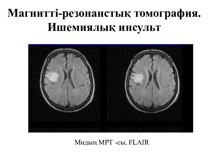 Магнитті-резонанстық томография. Ишемиялық инсульт Мидың МРТ -сы, FLAIR