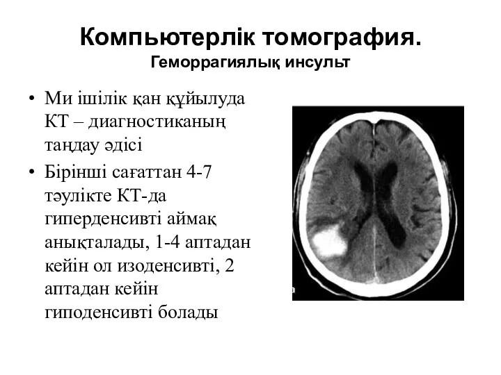 Компьютерлік томография. Геморрагиялық инсульт Ми ішілік қан құйылуда КТ –