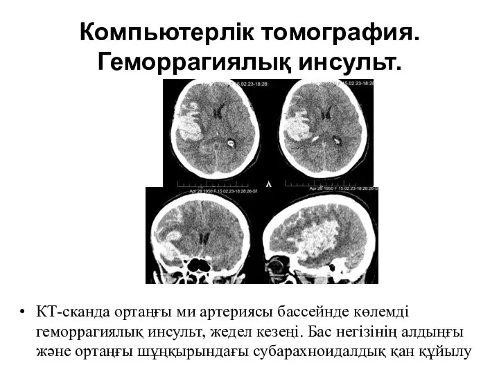 Компьютерлік томография. Геморрагиялық инсульт. КТ-сканда ортаңғы ми артериясы бассейнде көлемді