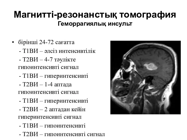 Магнитті-резонанстық томография Геморрагиялық инсульт бірінші 24-72 сағатта - Т1ВИ –