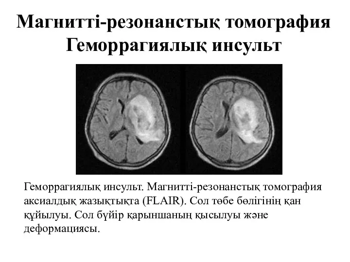 Магнитті-резонанстық томография Геморрагиялық инсульт Геморрагиялық инсульт. Магнитті-резонанстық томография аксиалдық жазықтықта