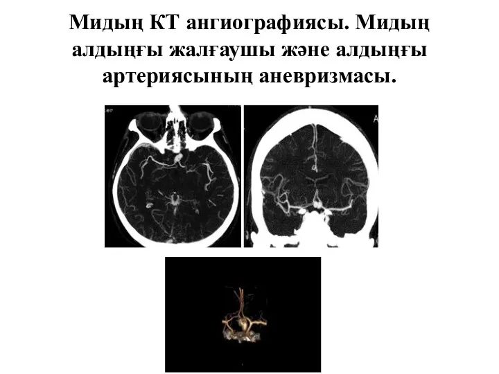 Мидың КТ ангиографиясы. Мидың алдыңғы жалғаушы және алдыңғы артериясының аневризмасы.