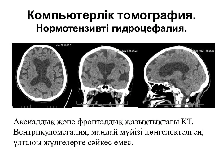 Компьютерлік томография. Нормотензивті гидроцефалия. Аксиалдық және фронталдық жазықтықтағы КТ. Вентрикуломегалия, маңдай мүйізі дөңгелектелген,ұлғаюы жүлгелерге сәйкес емес.