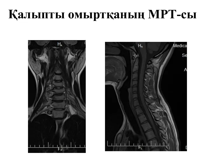 Қалыпты омыртқаның МРТ-сы