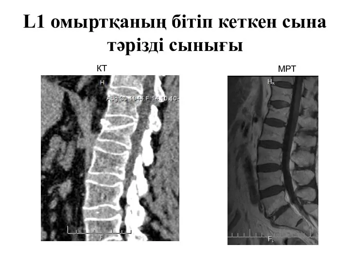 L1 омыртқаның бітіп кеткен сына тәрізді сынығы КТ МРТ