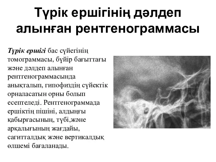 Түрік ершігінің дәлдеп алынған рентгенограммасы Түрік ершігі бас сүйегінің томограммасы,