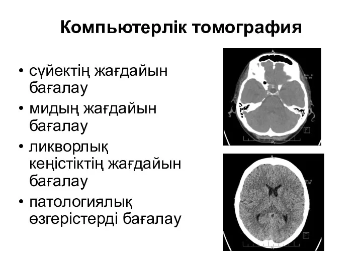 Компьютерлік томография сүйектің жағдайын бағалау мидың жағдайын бағалау ликворлық кеңістіктің жағдайын бағалау патологиялық өзгерістерді бағалау