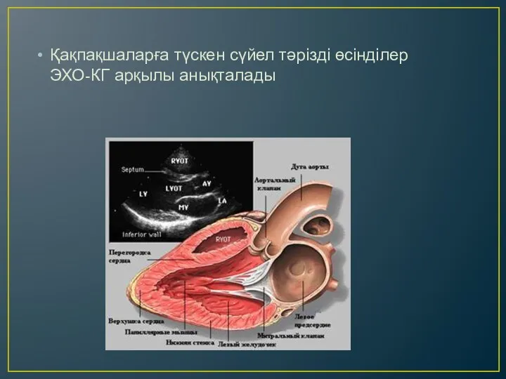 Қақпақшаларға түскен сүйел тәрізді өсінділер ЭХО-КГ арқылы анықталады