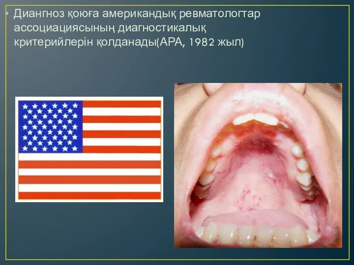 Диангноз қоюға американдық ревматологтар ассоциациясының диагностикалық критерийлерін қолданады(АРА, 1982 жыл)