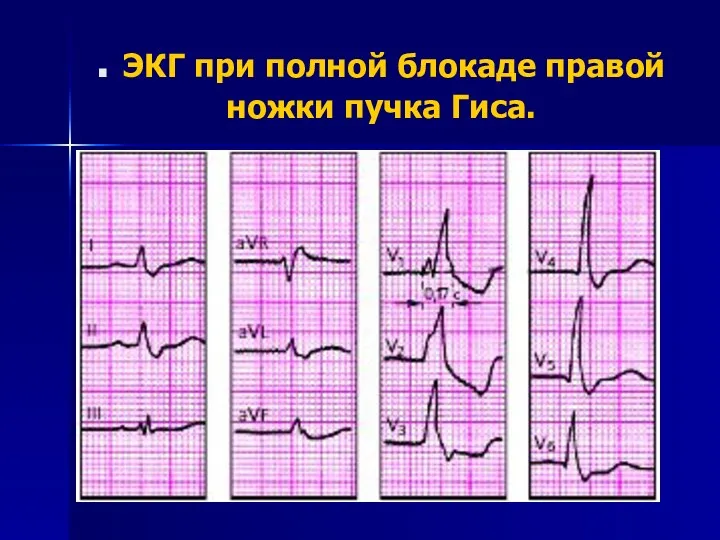 . ЭКГ при полной блокаде правой ножки пучка Гиса.